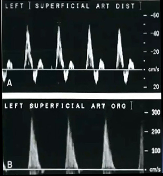 Допплеровское исследование артерий конечностей: А - нормальный трехфазный сигнал