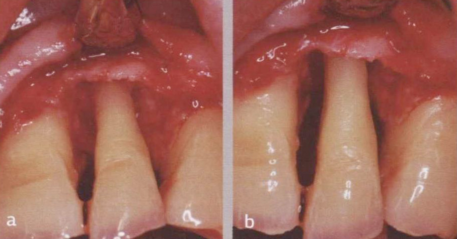Фото 1.9. Хирургический вид воронкообразного костного дефекта вокруг зуба