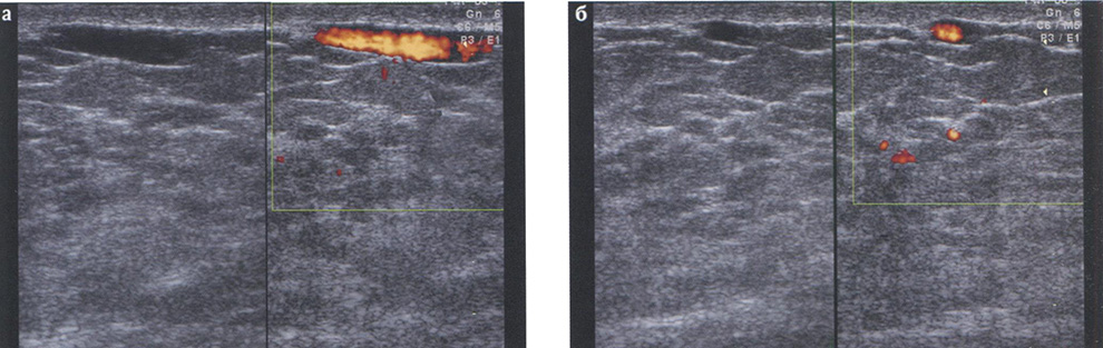 Визуализация подкожной вены: а — продольное сканирование, В-режим + режим ЭД