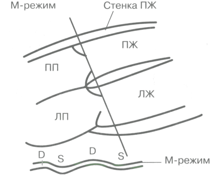 Гипертрофия стенки правого желудочка