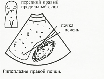 Гипоплазия правой почки