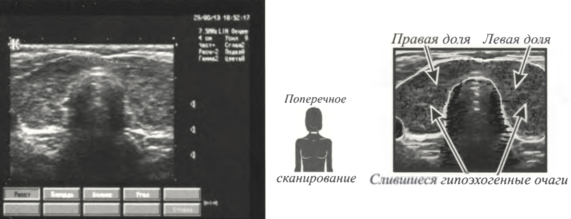 УЗИ диагностика щитовидной железы. Острый тиреоидит
