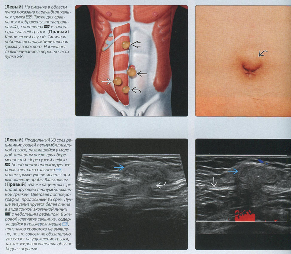 Грыжа брюшной стенки. УЗИ диагностика