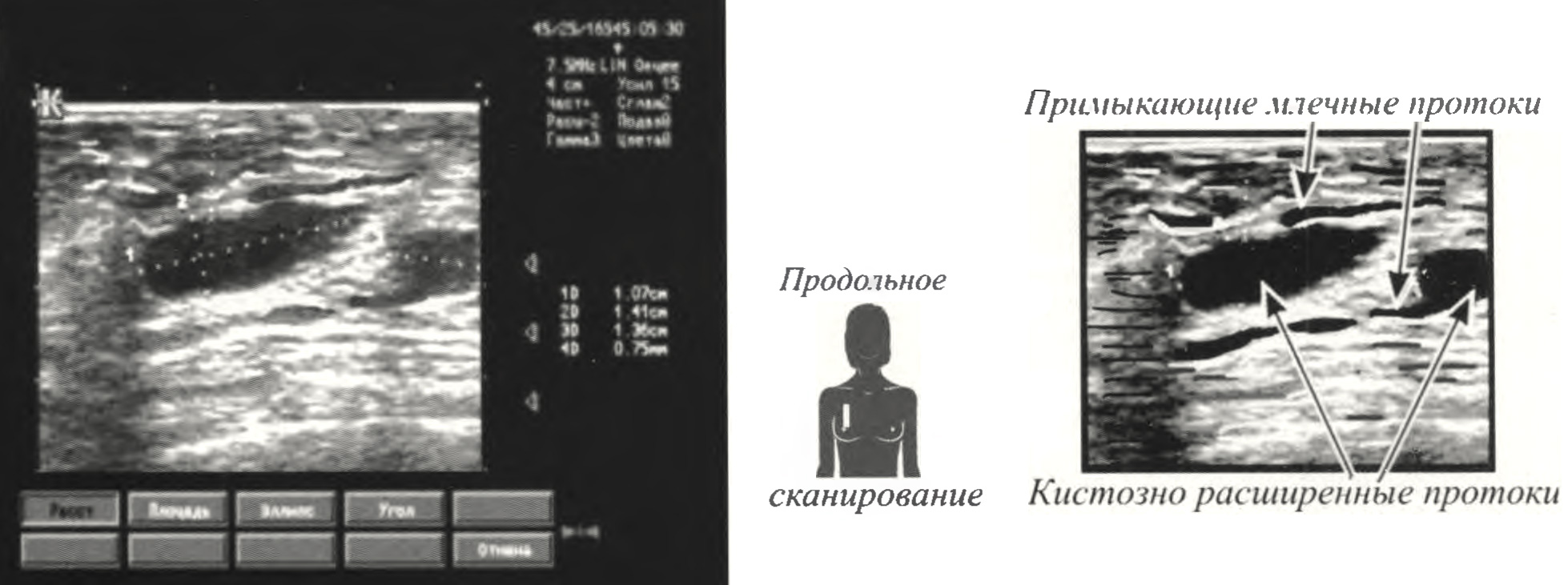 Диффузная фиброзно-кистозная мастопатия УЗ - признаки