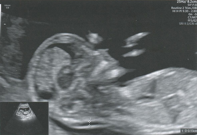 Измерение ТВП у плода в I триместре беременности согласно правилам FMF: срок беременности - 11-14 нед (копчико-теменной размер 45-84 мм)