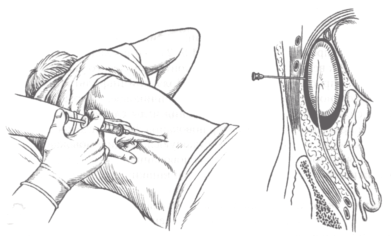 Блокада паранефральная (поясничная)