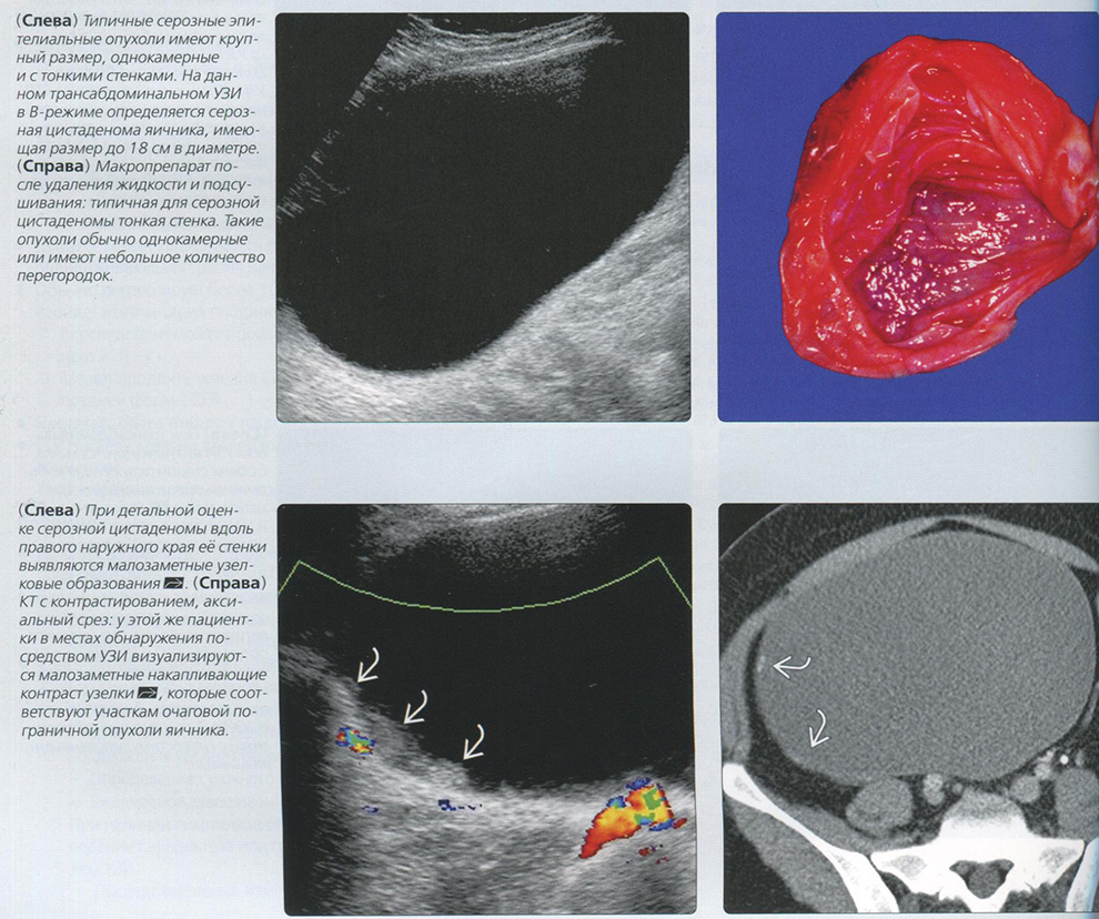 Серозная цистаденома яичника / цистаденокарцинома. УЗИ, КТ диагностика