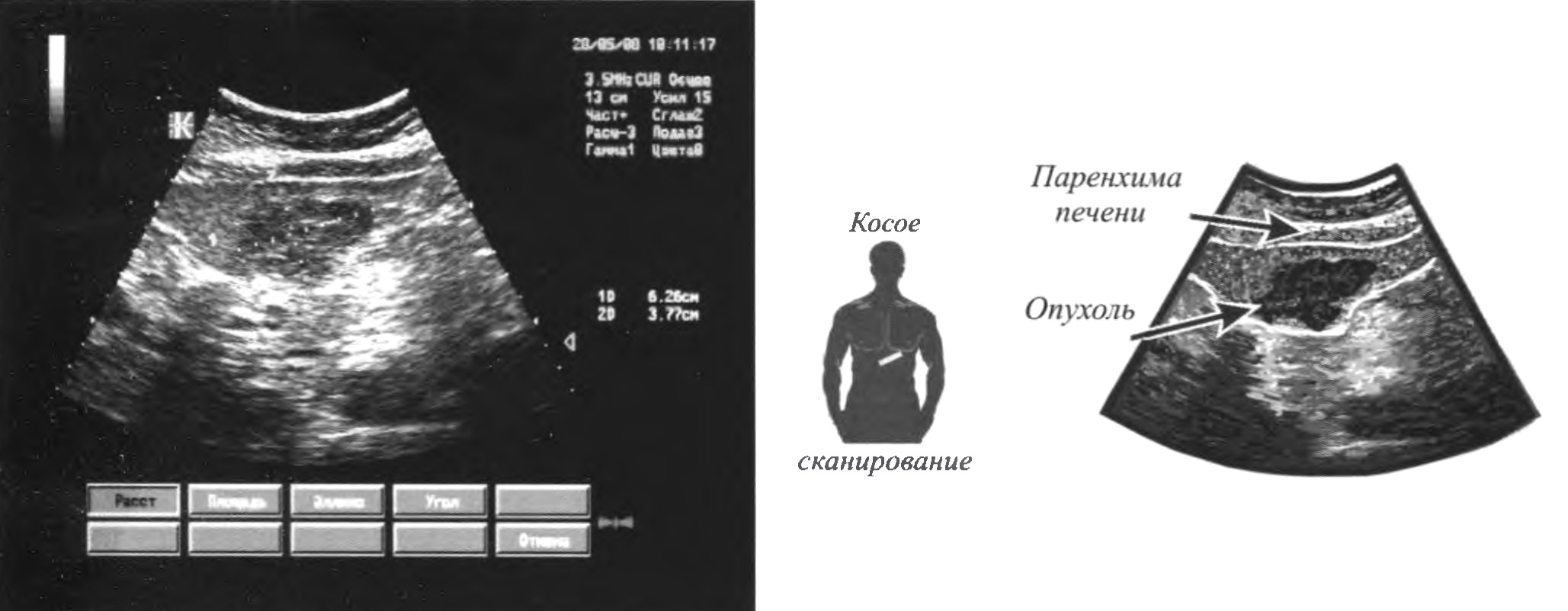 Первичный рак левой доли печени: наружный контур 2-го сегмента печени деформирован объёмным образованием