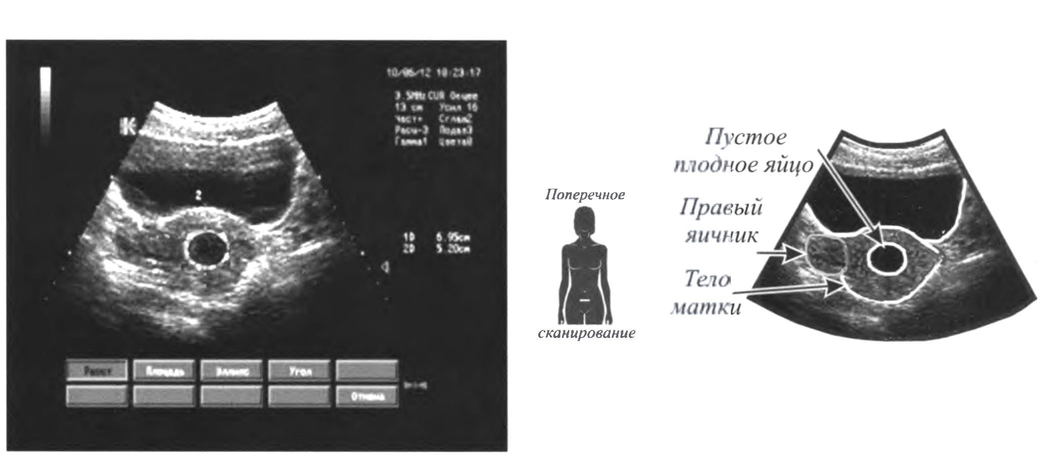 Неразвивающаяся беременность, анэмбриония. УЗ - признаки: 1 - если при сроке беременности 5-6 недель и более в полости плодного яйца
