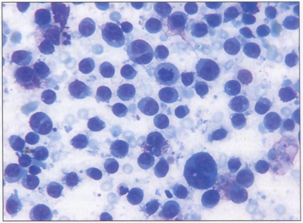 Клетки лимфоидного ряда с признаками атипии, митозами в плевральном выпоте при лимфоме