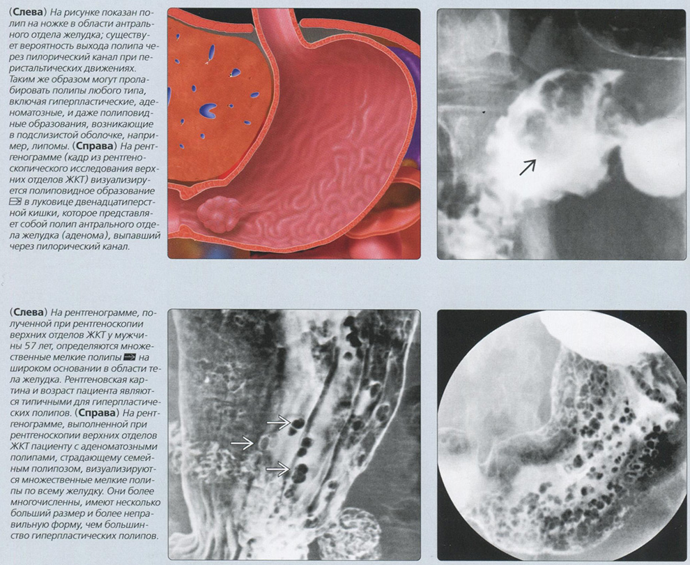 Рентген. Полипы желудка