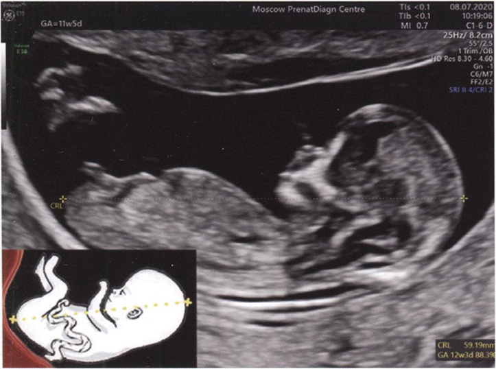 Эхограмма и схема измерения КТР плода Эхограмма и схема измерения КТР плода