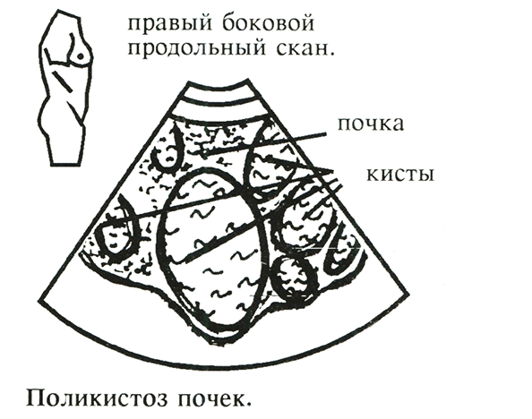 Поликистоз почек