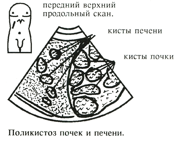 Поликистоз почек и печени