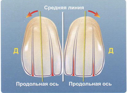 Выравнивание вестибулярной поверхности по продольной оси