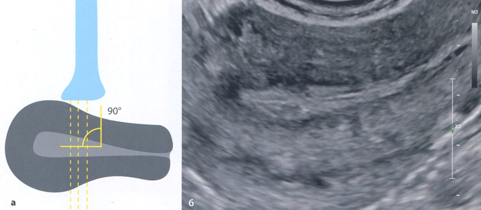 Расположение матки для оценки состояния эндометрия: а - схема, на которой показано расположение датчика под углом 90° по отношению к эндометрию