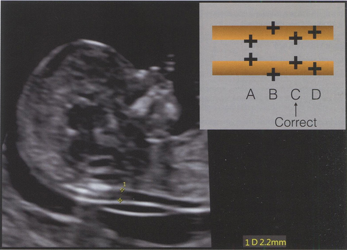 Ультразвуковое изображение среднесагиттального среза головы плода в 13 нед беременности Ультразвуковое изображение среднесагиттального среза головы плода в 13 нед беременности