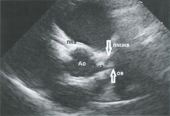 Рис. 1. Парастернальная позиция короткой оси на уровне аортального клапана