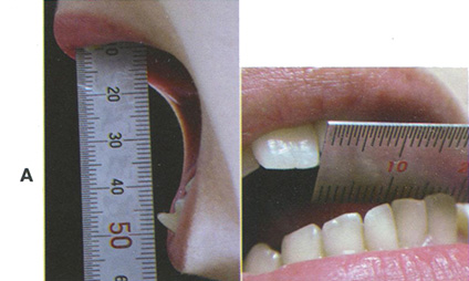 Максимальное открывание нижней челюсти, превышающее 50 мм