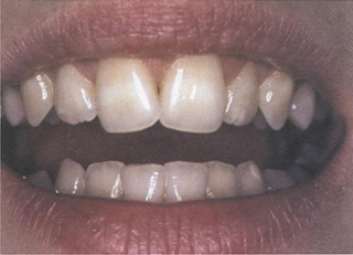 Во время обследования оценивается так называемое негативное пространство между зубами