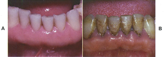 Здоровая десна: розового цвета, с острым краем и плотно прилегающая к зубу