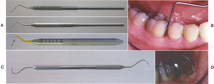  Три типа измеряющих десневую борозду/карман зондов