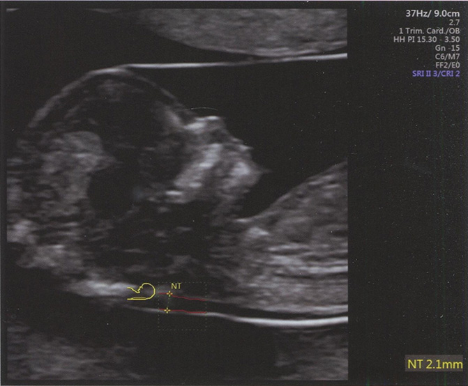 Ультразвуковое изображение среднесагиттального среза головы плода в 12 нед беременности Ультразвуковое изображение среднесагиттального среза головы плода в 12 нед беременности