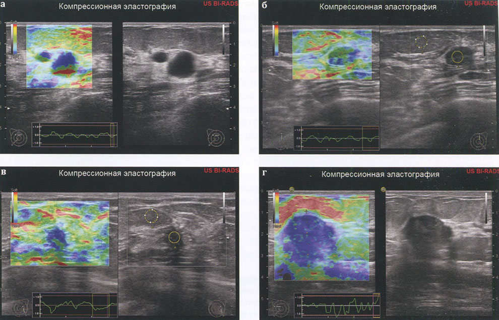 Рис. 1. Компрессионная эластография: