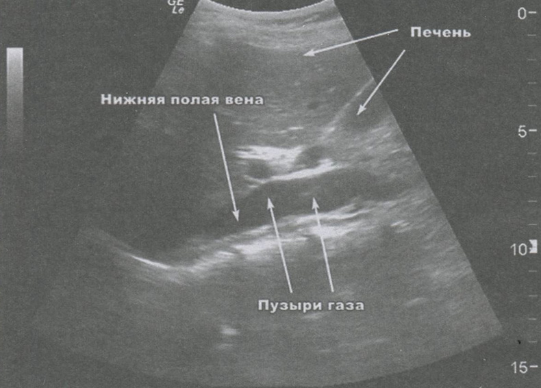 Рис. 1.3. Пузыри газа в нижней полой вене, регистрируемые в процессе ЭВЛО. Ультразвуковая сканограмма