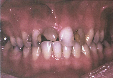 Непривлекательный внешний вид зубов 