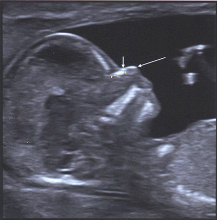 Среднесагиттальный срез головы плода в 13 нед беременности, демонстрирующий нормальное изображение носовой кости (НК) Среднесагиттальный срез головы плода в 13 нед беременности, демонстрирующий нормальное изображение носовой кости (НК)