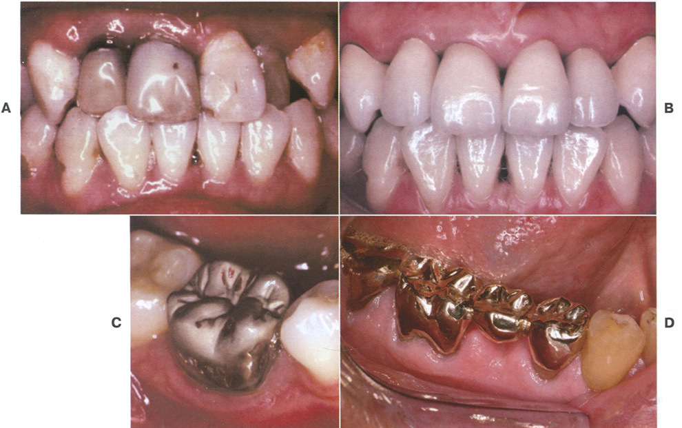Верхнечелюстные зубы с сильной степенью разрушения