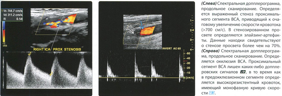 УЗИ диагностика. Стеноз сонной артерии. Окклюзия сонной артерии