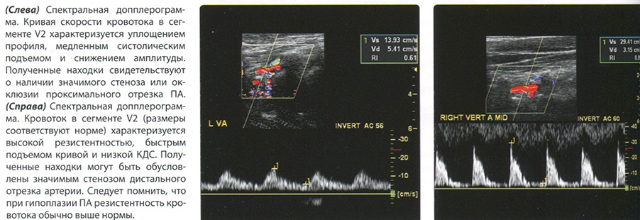 УЗИ диагностика Стеноз позвоночной артерии. Окклюзия позвоночной артерии.