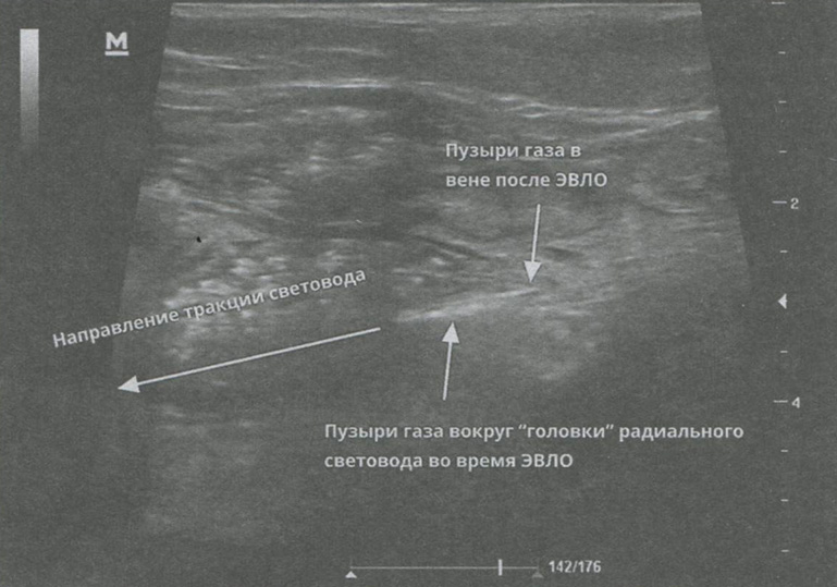 Рис. 1.4. Пузыри газа в стенке вены и вокруг «головки» световода, регистрируемые в процессе ЭВЛО