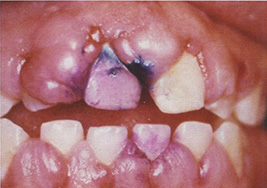 Тяжелая форма гиперплазии десен