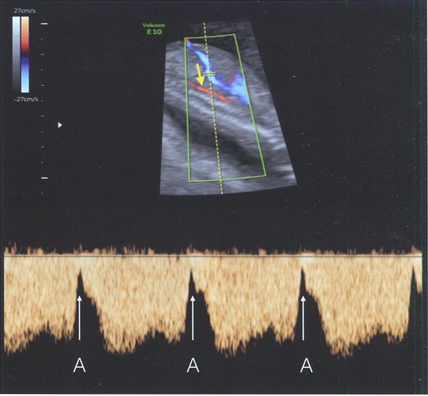 Парасагиттальное сечение живота и грудной клетки плода с использованием ЦДК и импульсноволнового режима Парасагиттальное сечение живота и грудной клетки плода с использованием ЦДК и импульсноволнового режима