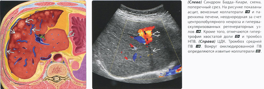 УЗИ диагностика. Синдром Бадда-Киари