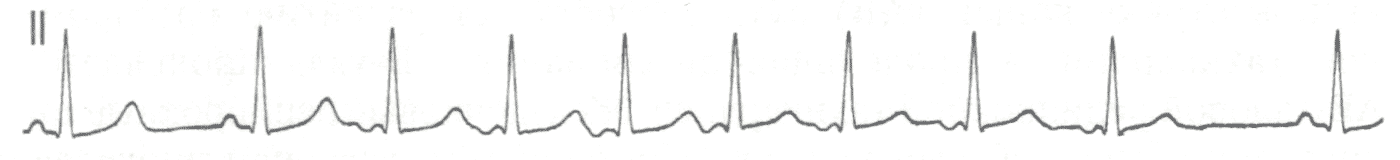 Постепенное начало и окончание эктопической предсердной тахикардии