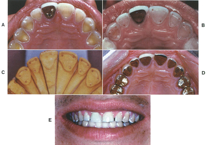  Обширное поражение, вызванное самопроизвольной кислотной регургитацией