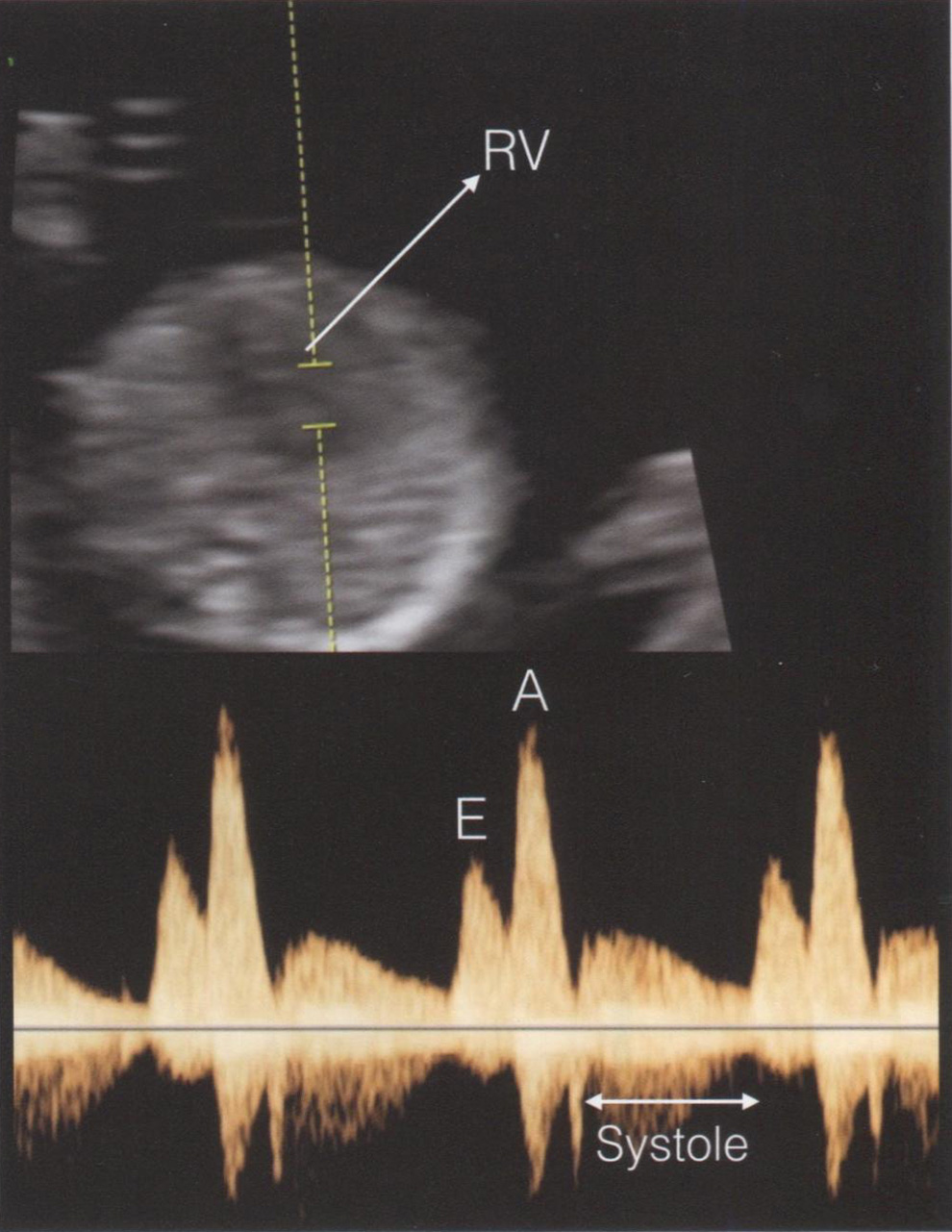 Аксиальная плоскость сканирования грудной клетки плода в 13 нед беременности Аксиальная плоскость сканирования грудной клетки плода в 13 нед беременности