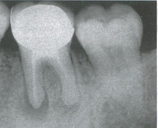  Неадекватное эндодонтическое лечение привело к рецидиву периапикального поражения