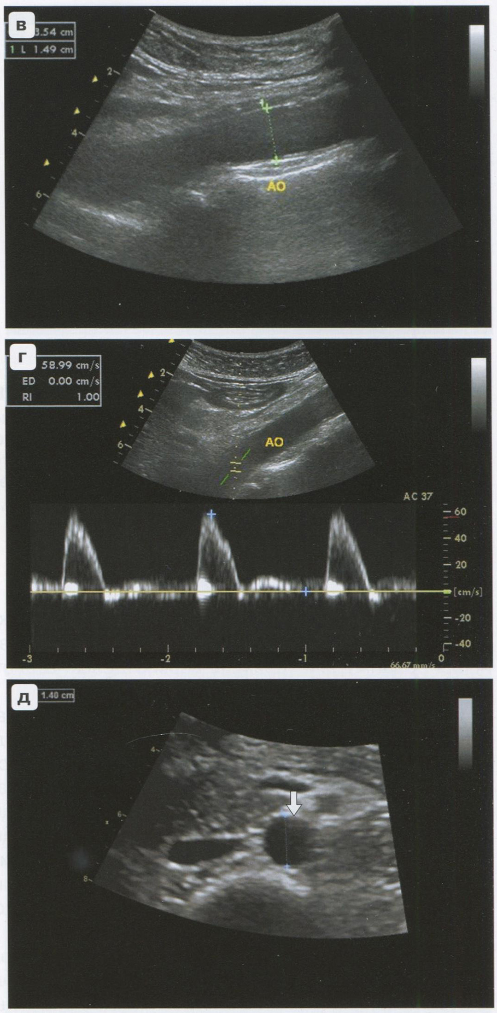 Дуплексное сканирование брюшного отдела аорты (стрелка на д). Продольная проекция (в), поперечная проекция (д)