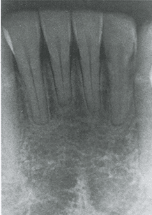 Апикальная резорбция корня после ортодонтического лечения