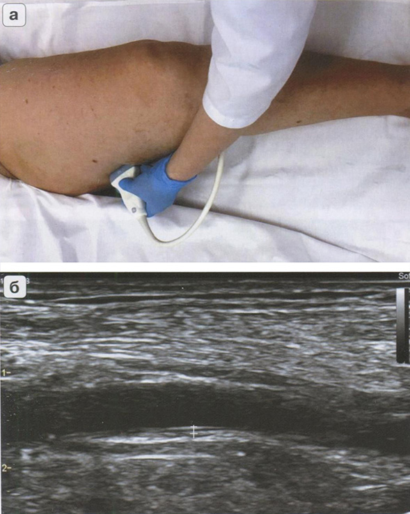  Методика проведения дуплексного сканирования общей бедренной артерии