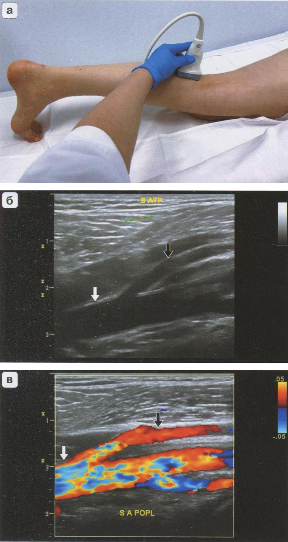Методика проведения дуплексного сканирования артерий подколенной области