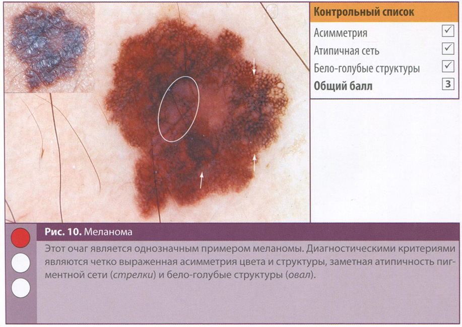 Рис. 10. Меланома