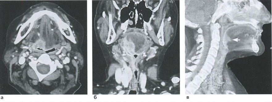 Рак корня языка, выявляющийся на аксиальных (а) и фронтальных (6) срезах, а также в сагиттальном объемном представлении (в)