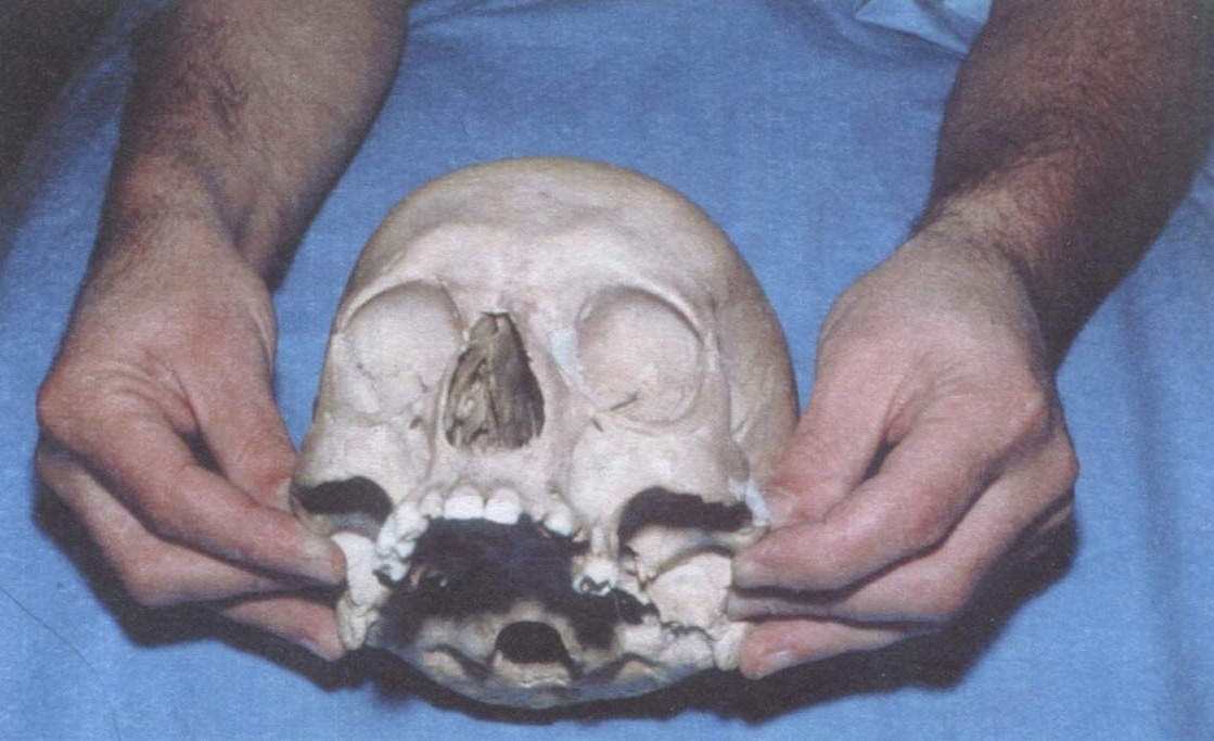 Рис. 10. Пальпация височных костей