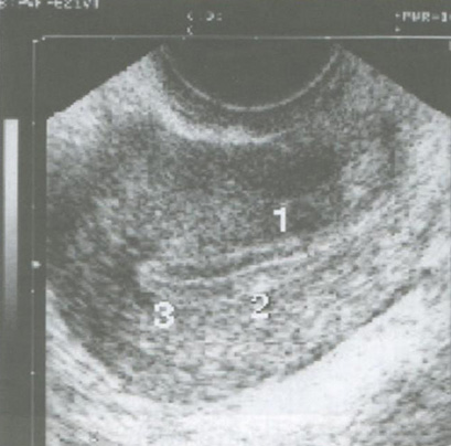 Очаговая гиперплазия эндометрия.